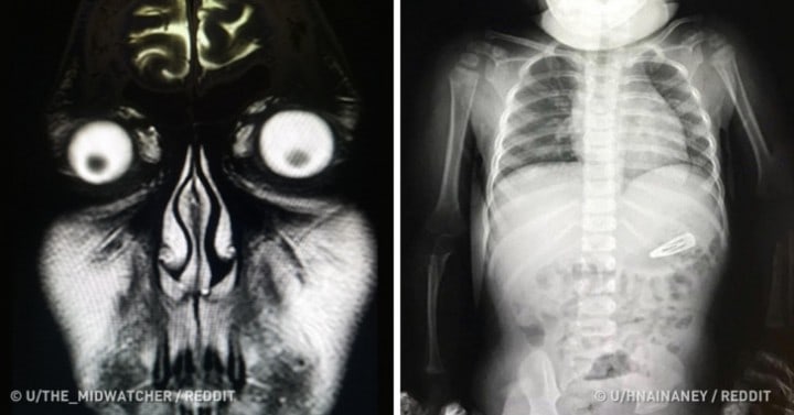 Furcsa röntgenfotók, amiken az orvosok is ledöbbentek