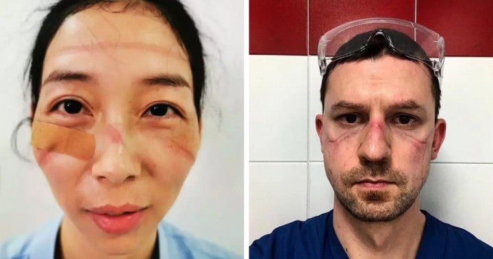 Az egészségügyi dolgozók megmutatták, hogyan néz ki az arcuk a koronavírusos betegek ápolása után