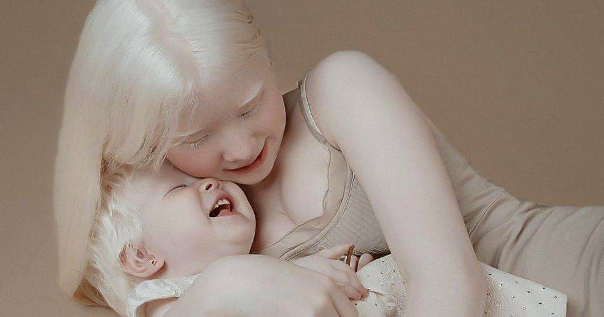 A 12 év különbséggel született albínó testvérek angyali képein ámul most az internet