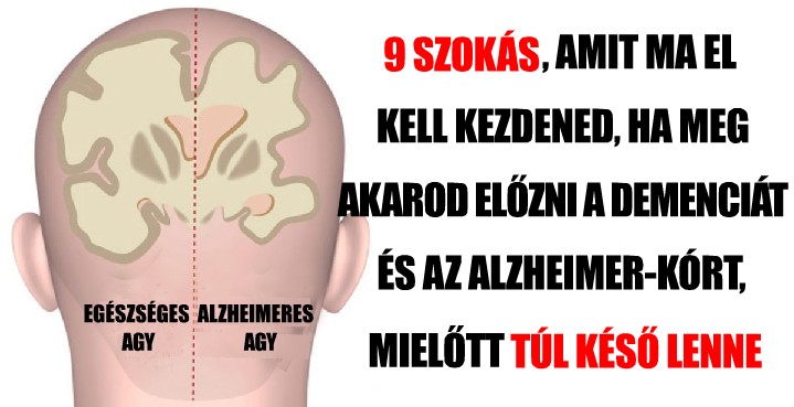 9 szokás, amit még ma el kell kezdened, hogy megelőzd a demencia és az Alzheimer-kórt, mielőtt már túl késő lenne
