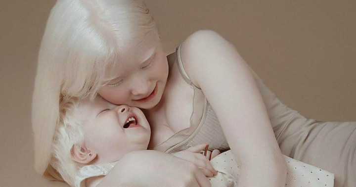 15 fotó egy albínó testvérpárról akik egyszerűen gyönyörűek