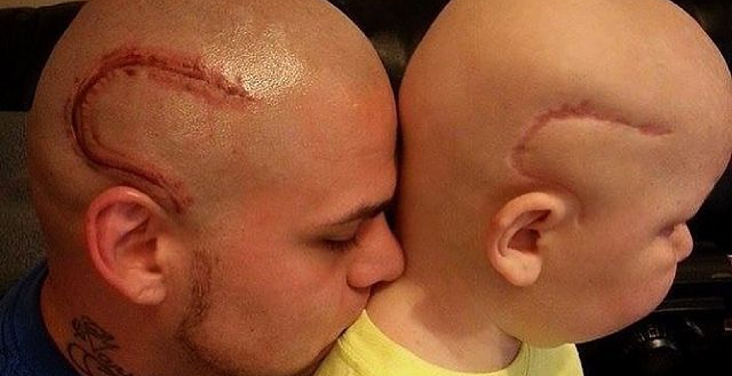 A apa magára tetováltatott egy heget, hogy a beteg fia ne érezze magát kirekesztve a műtéti sebe miatt